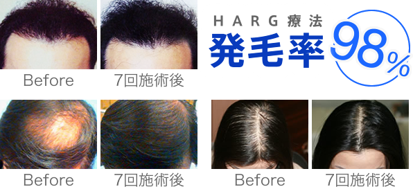 HARG療法は発毛率98%
